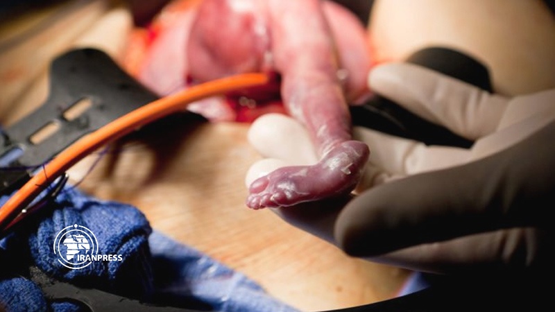 Iranpress: Rare fetal surgery in Shiraz, Iran