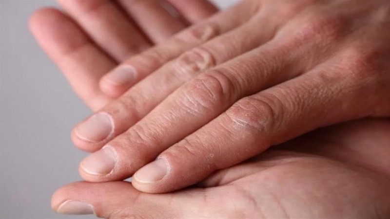 Iranpress: تعرف على علامات في الأصابع تشير إلى الإصابة بسرطان الرئة