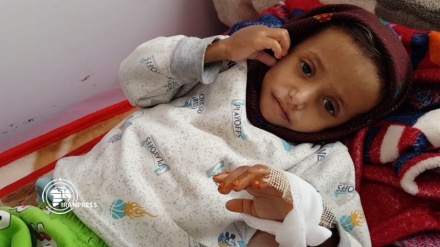 شاهد ما تسببت به الحرب الدائرة في اليمن من سوء التغذية الحاد لدى الأطفال
