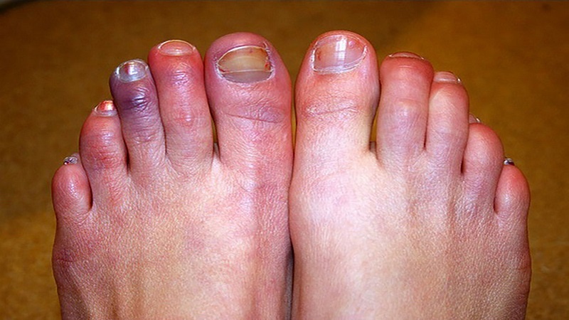 Iranpress: الكشف عن أعراض جديدة لمرض كورونا ما يسمى بـ"أصابع كوفيدـ19"
