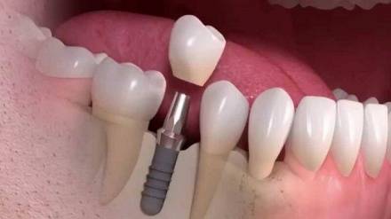 مزایای ایمپلنت دندان با شرایط اقساط